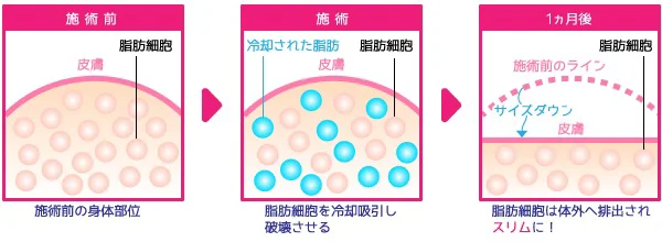 脂肪冷却③ 脂肪冷却